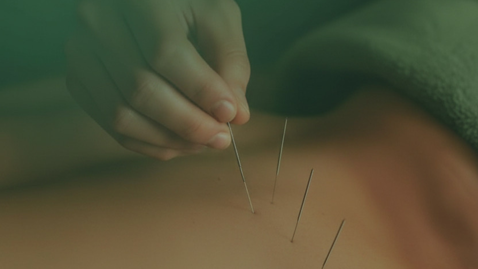 الوخز بالإبر الجاف